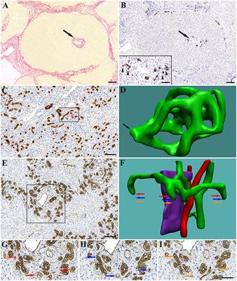 What Makes Cirrhosis Irreversible?—Consideration on Structural Changes